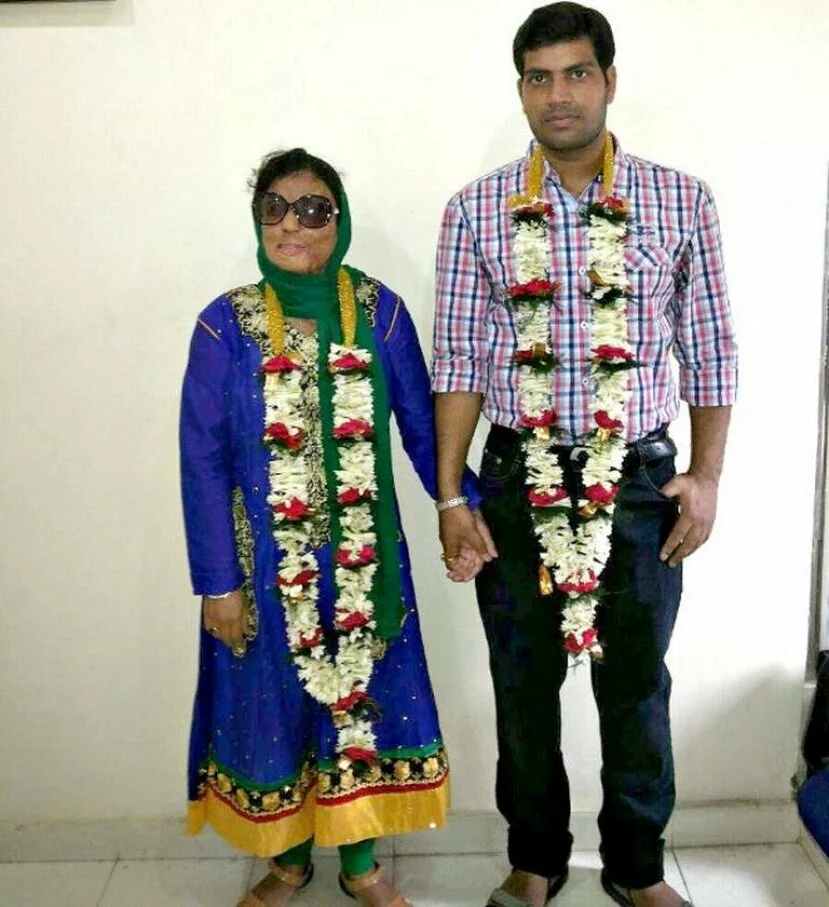 Man sets example by marrying acid victim
